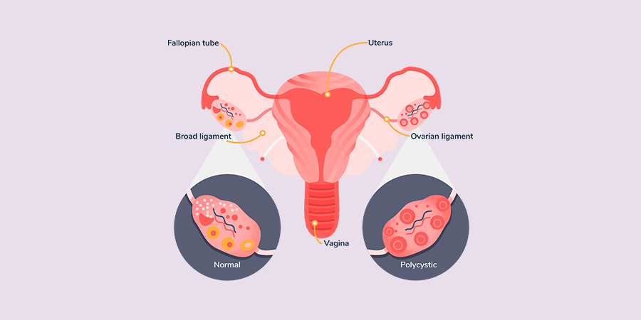 PCOS Info Graphic